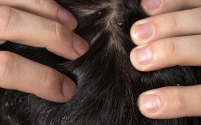 The Relationship Between Lice Infestations and Hair Loss